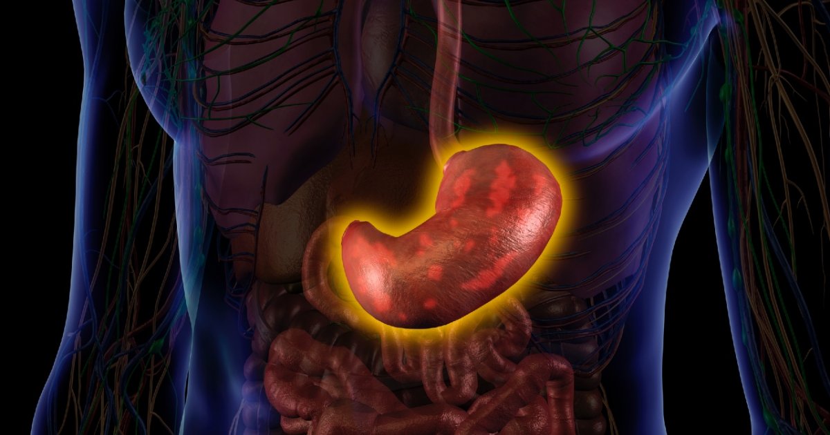 Úlcera péptica